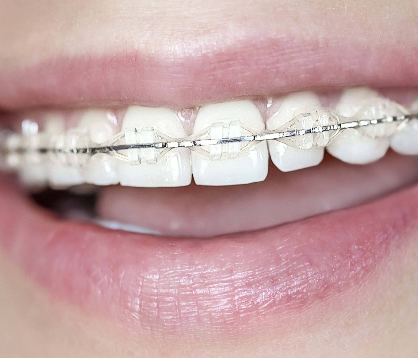 Ceramic Braces Amazing Smiles