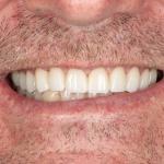 Smile Makeovers - Amazing Smiles Enhanced oral health