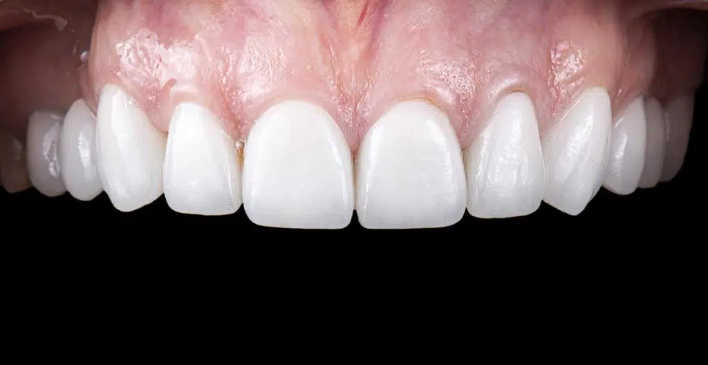 Are Teeth Whitening Effective On Porcelain Veneers, And How Do I Maintain Their Brightness?