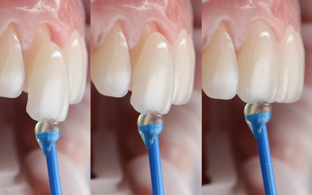 The Procedure Of Getting Porcelain Veneers