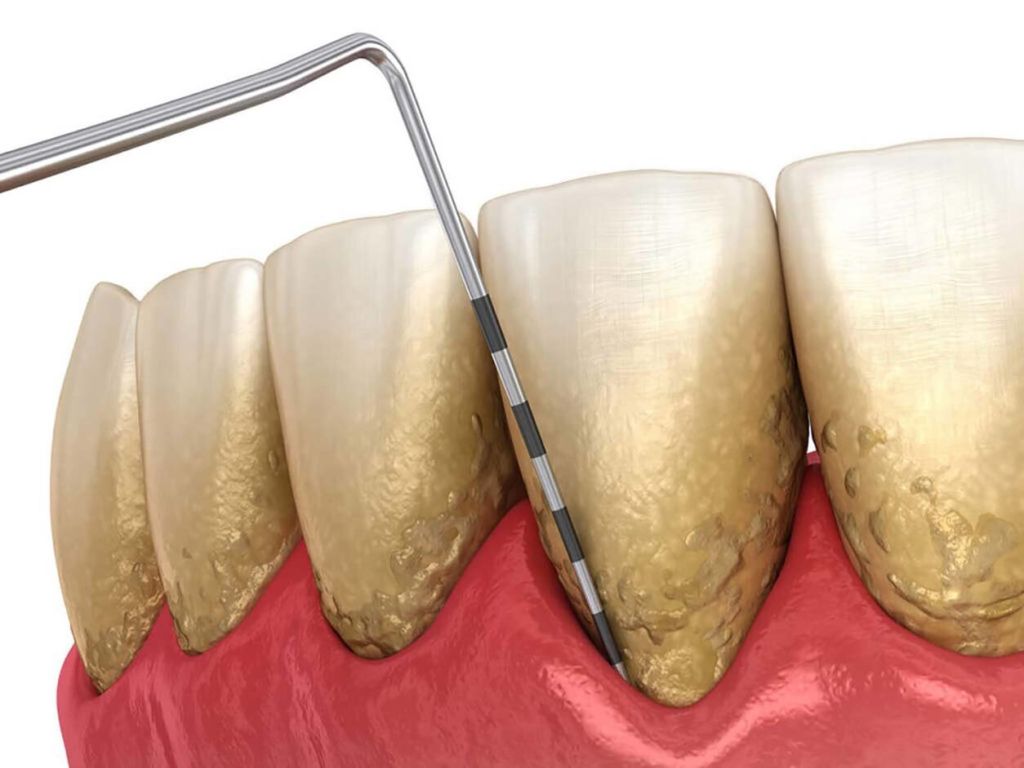 How Is Periodontitis Diagnosed