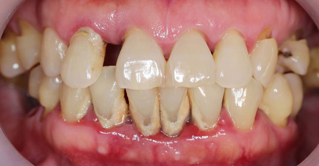 What Is Periodontitis