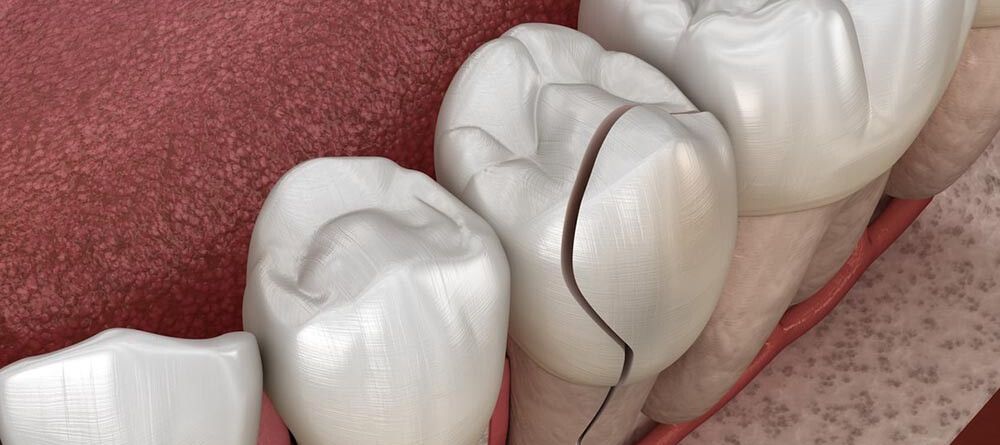 The Consequences of an Untreated Fractured Tooth