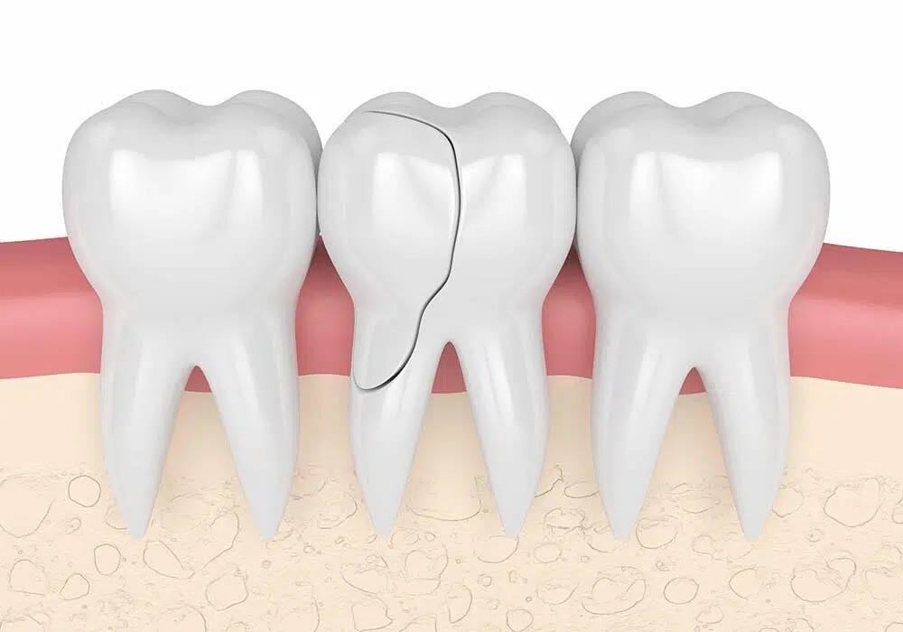 The Importance Of Treating A Fractured Tooth