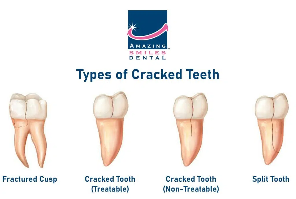 Untreated Fractured Tooth: 4 Types Of Cracked Teeth &Amp; Risks