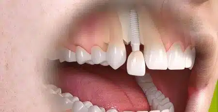 Dental Implant vs Implant Bridge