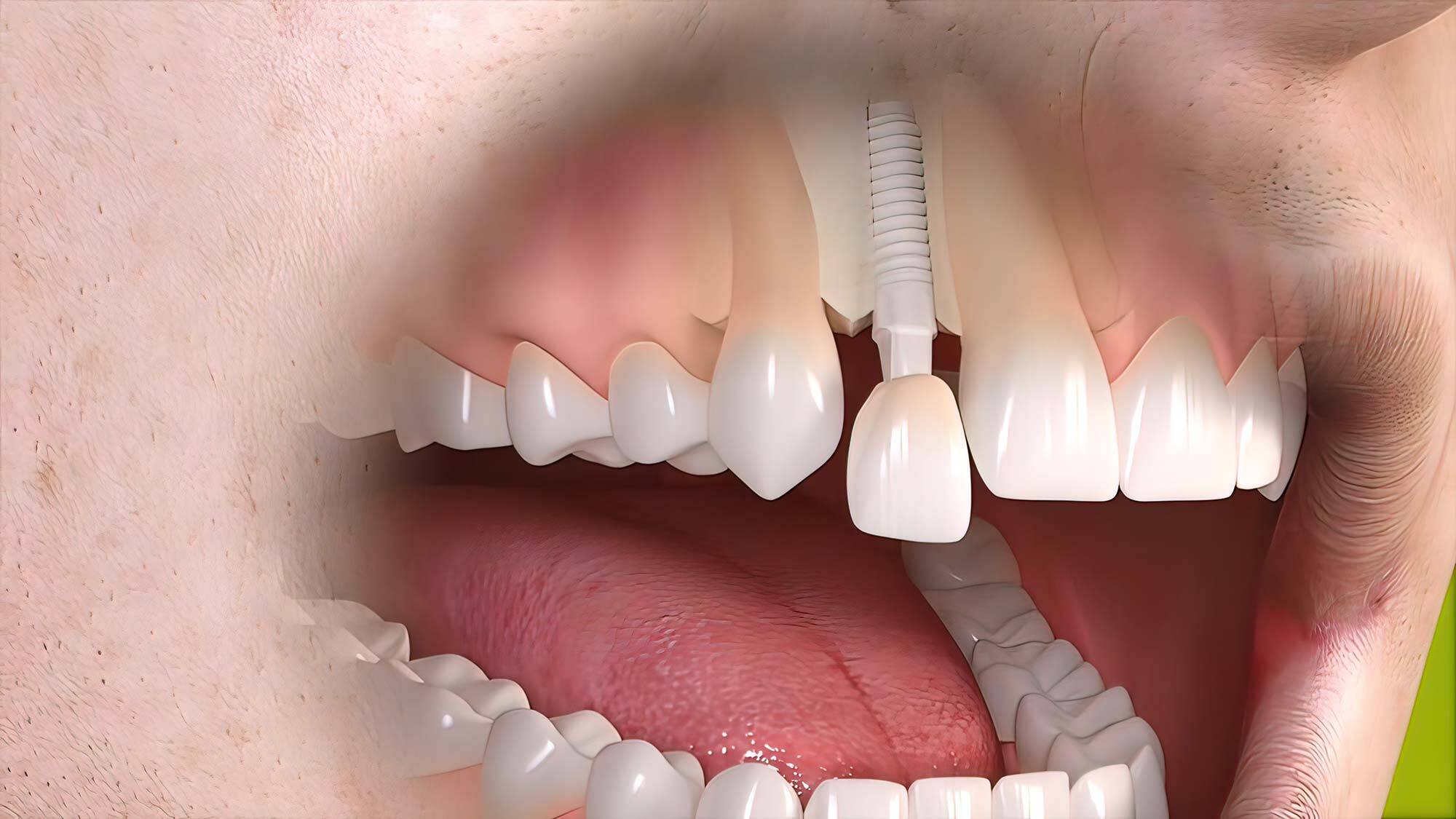 Dental Implant vs Implant Bridge