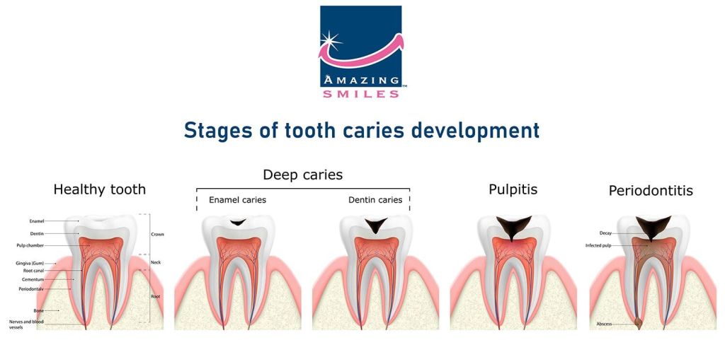 What Are Dental Cavities? Symptoms, Causes And Treatment