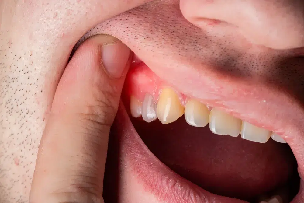 Symptoms Of Tooth Infection