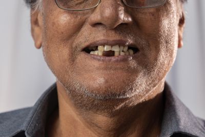 Is Natural Tooth Loss Hereditary?