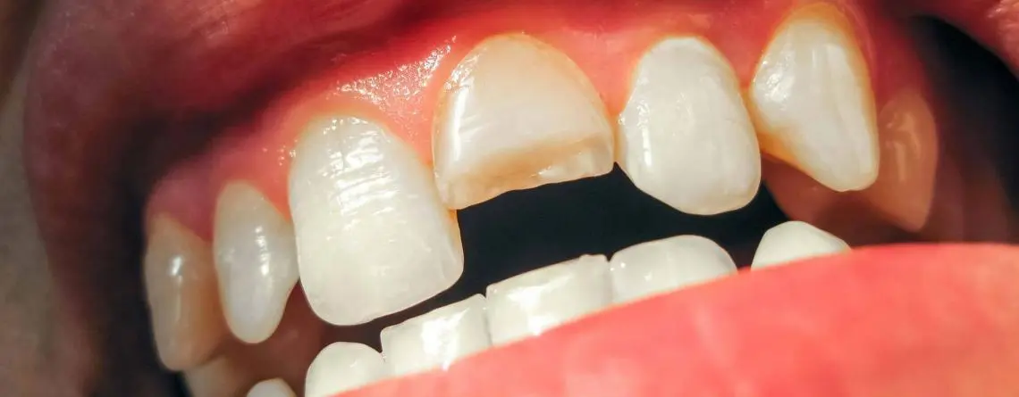 How To Fix A Chipped Or Broken Tooth