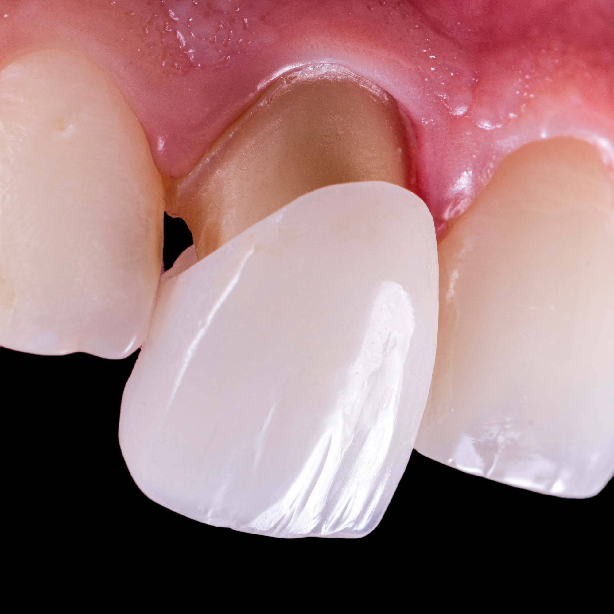 Tooth Decay underneath Crowns and Bridges