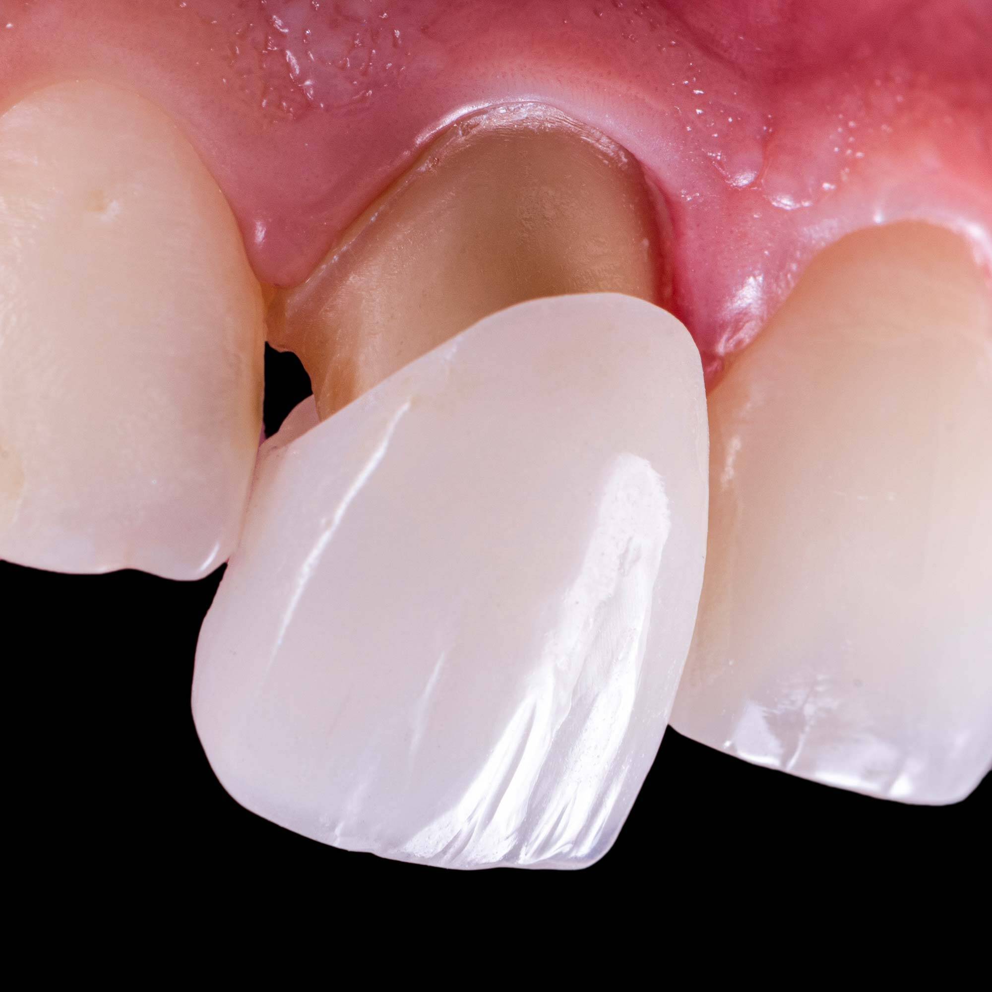 Tooth Decay Underneath Crowns And Bridges