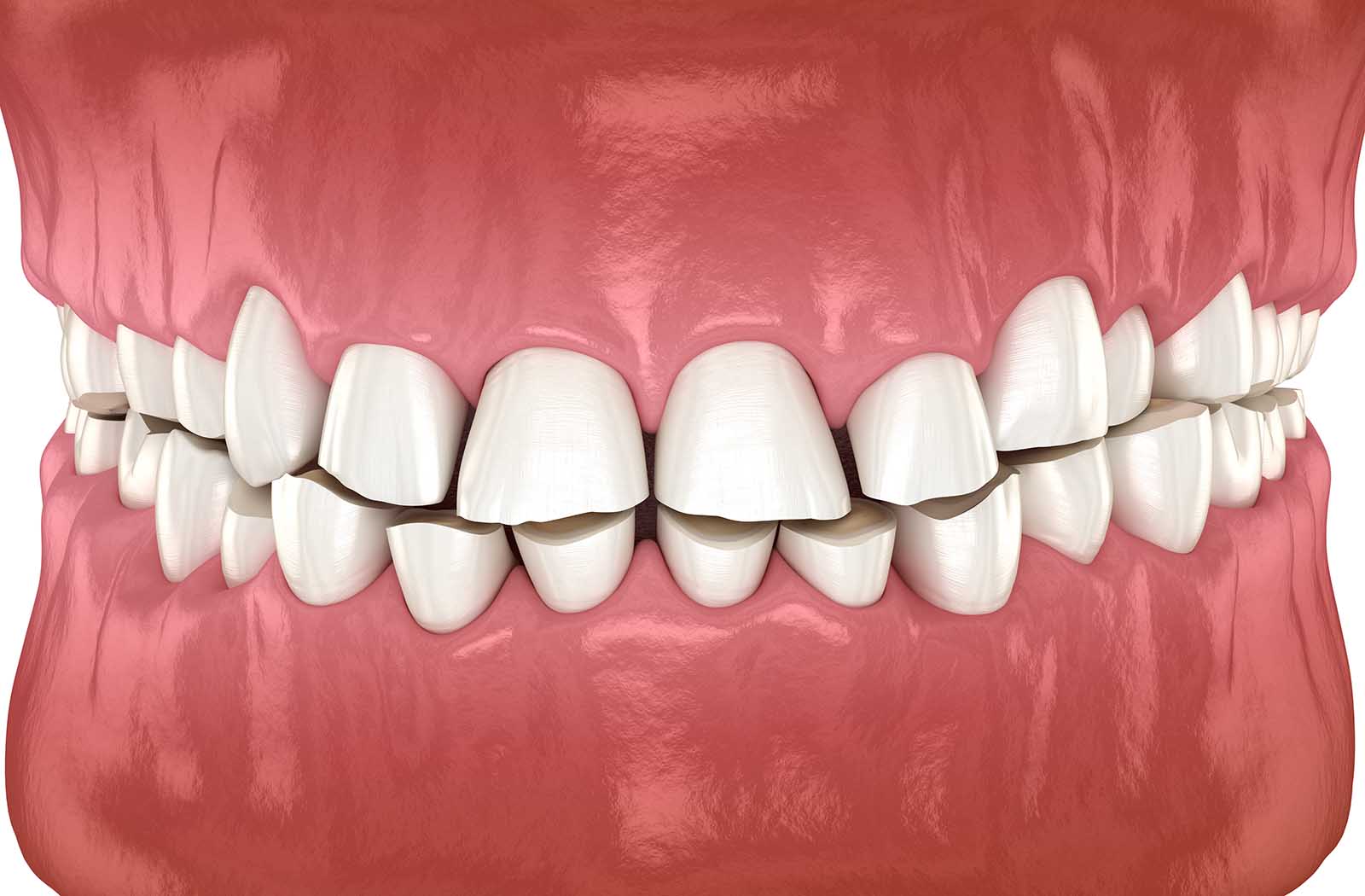 Illustration Of The Effects Of Long-Term Dental Attrition Bruxism - Teeth Grinding