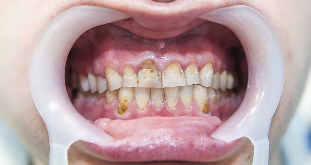 What Is Severe Dental Fluorosis?