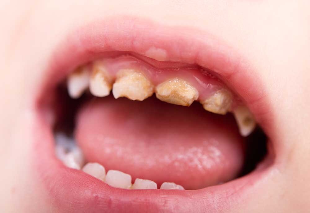 Kids Dentistry To Prevent Tooth Decay