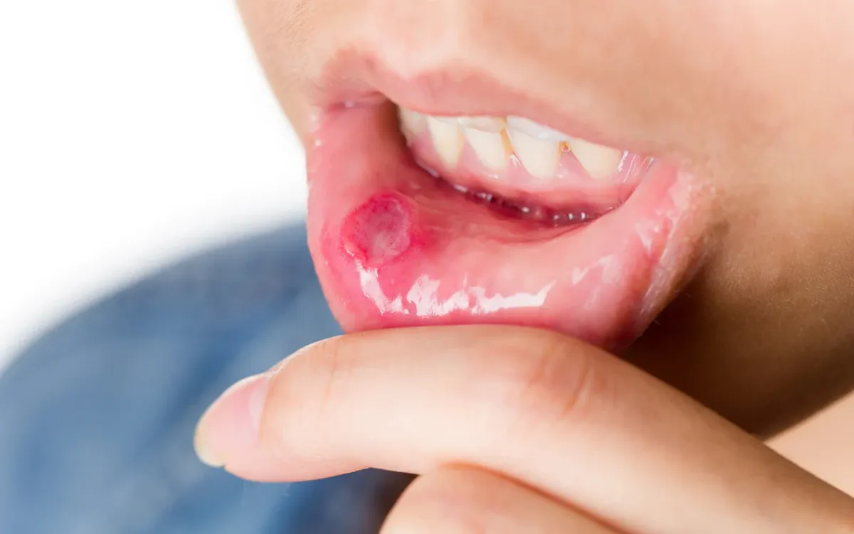 How Do You Treat Mouth Ulcers Or Canker Sores?