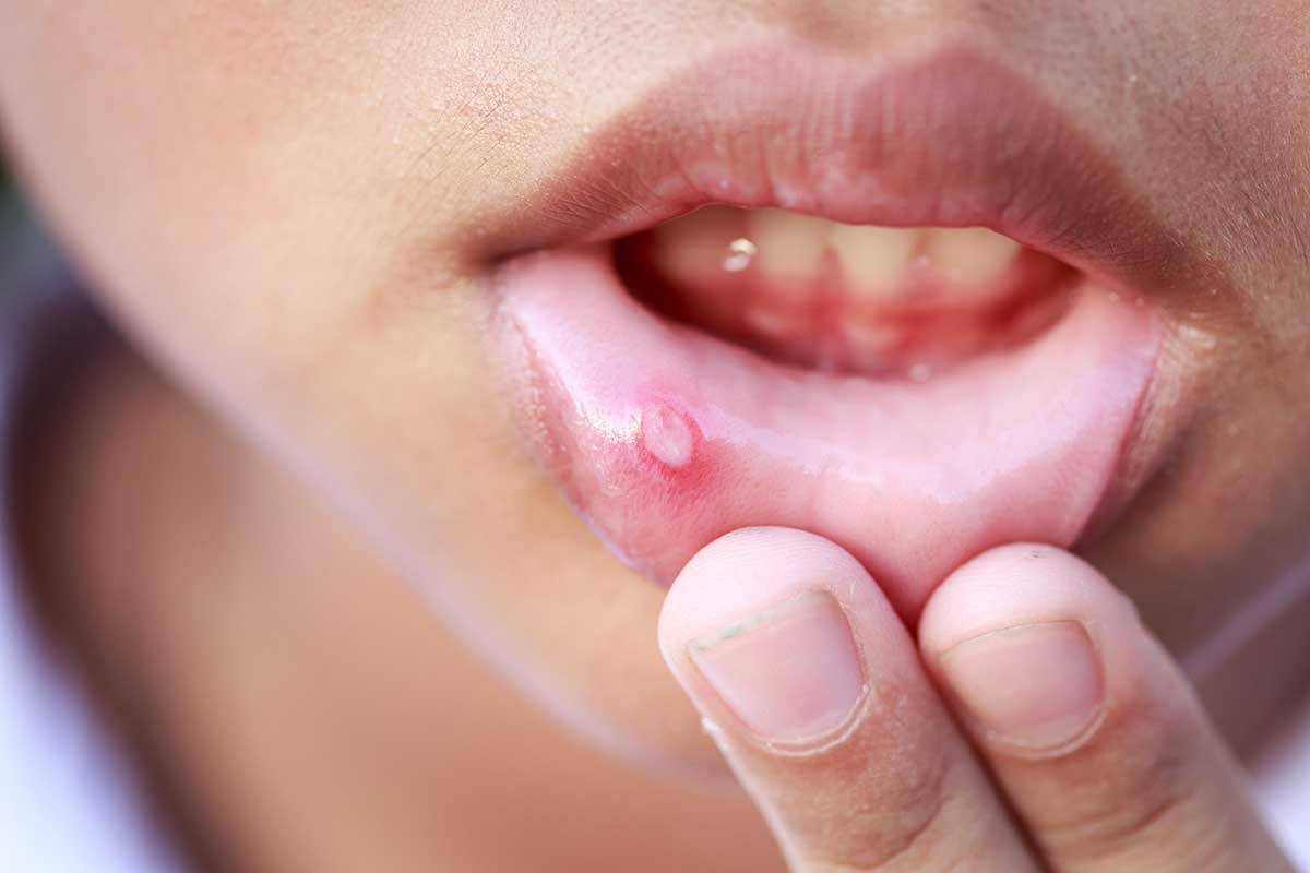 What Are Mouth Ulcers Or Canker Sores?