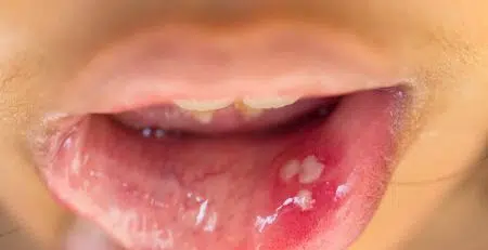 mouth ulcers