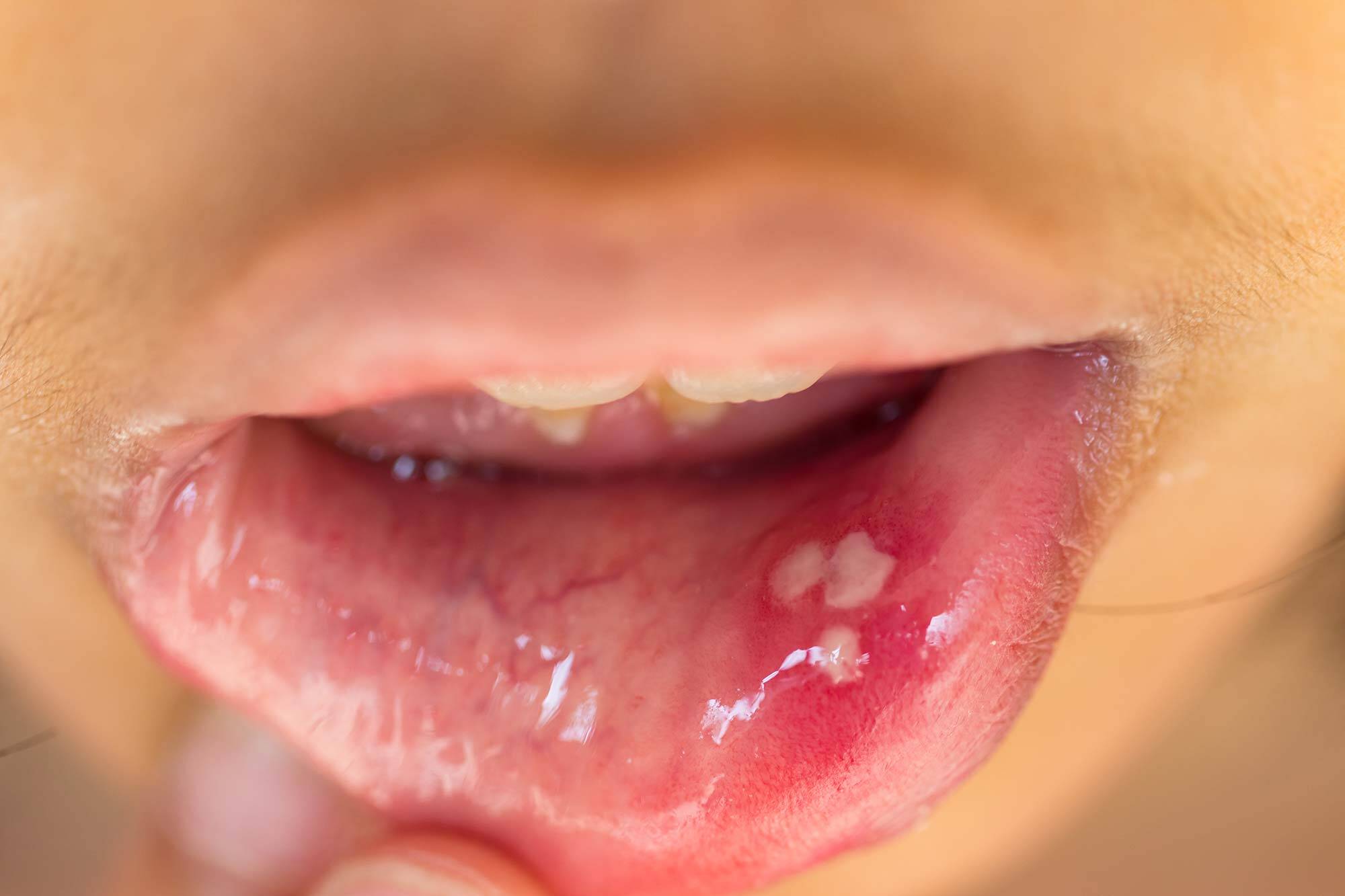 mouth-ulcers-canker-sores-causes-and-treatment-options