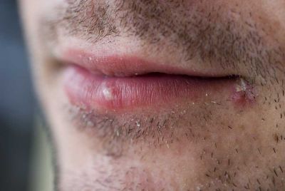 Transmission of Cold Sores