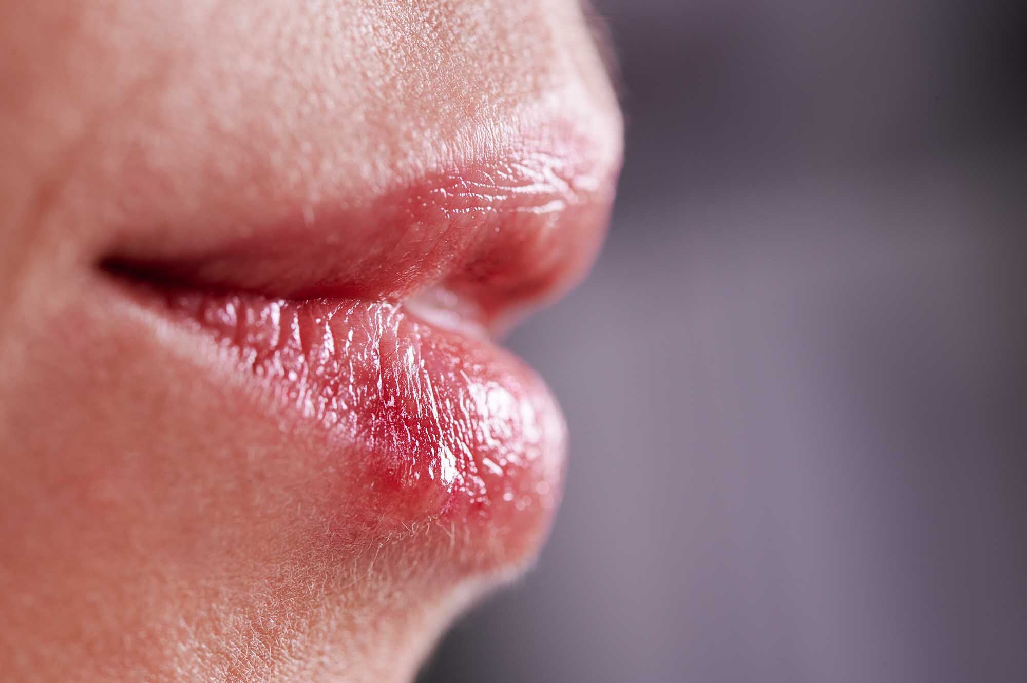 Cold Sores And Viral Infections From Sharing Drinks