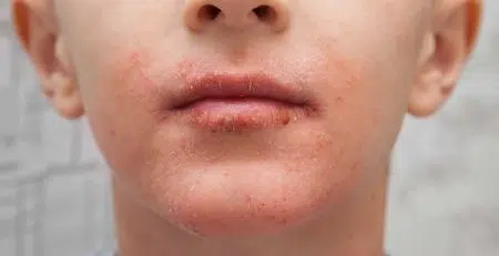 Mouth Rash