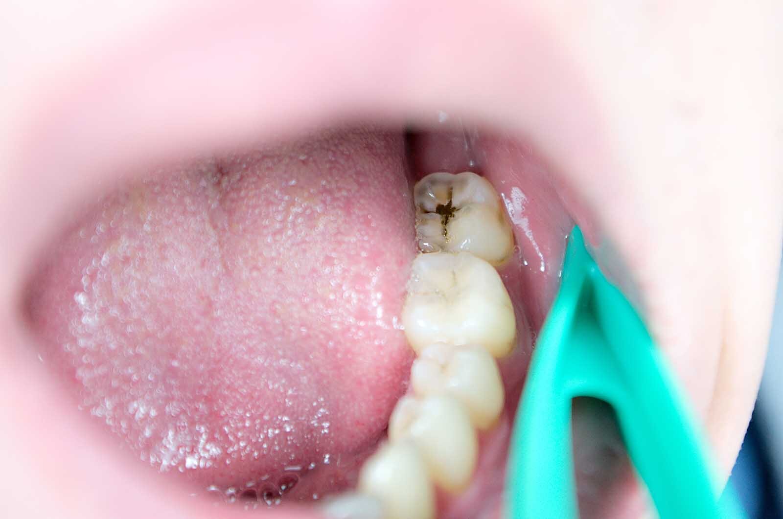 severe molar decay