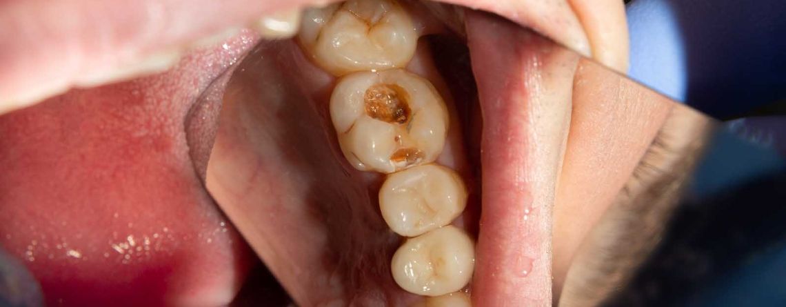 What are the signs of dental decay?