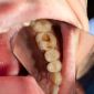 What are the signs of Dental Decay?