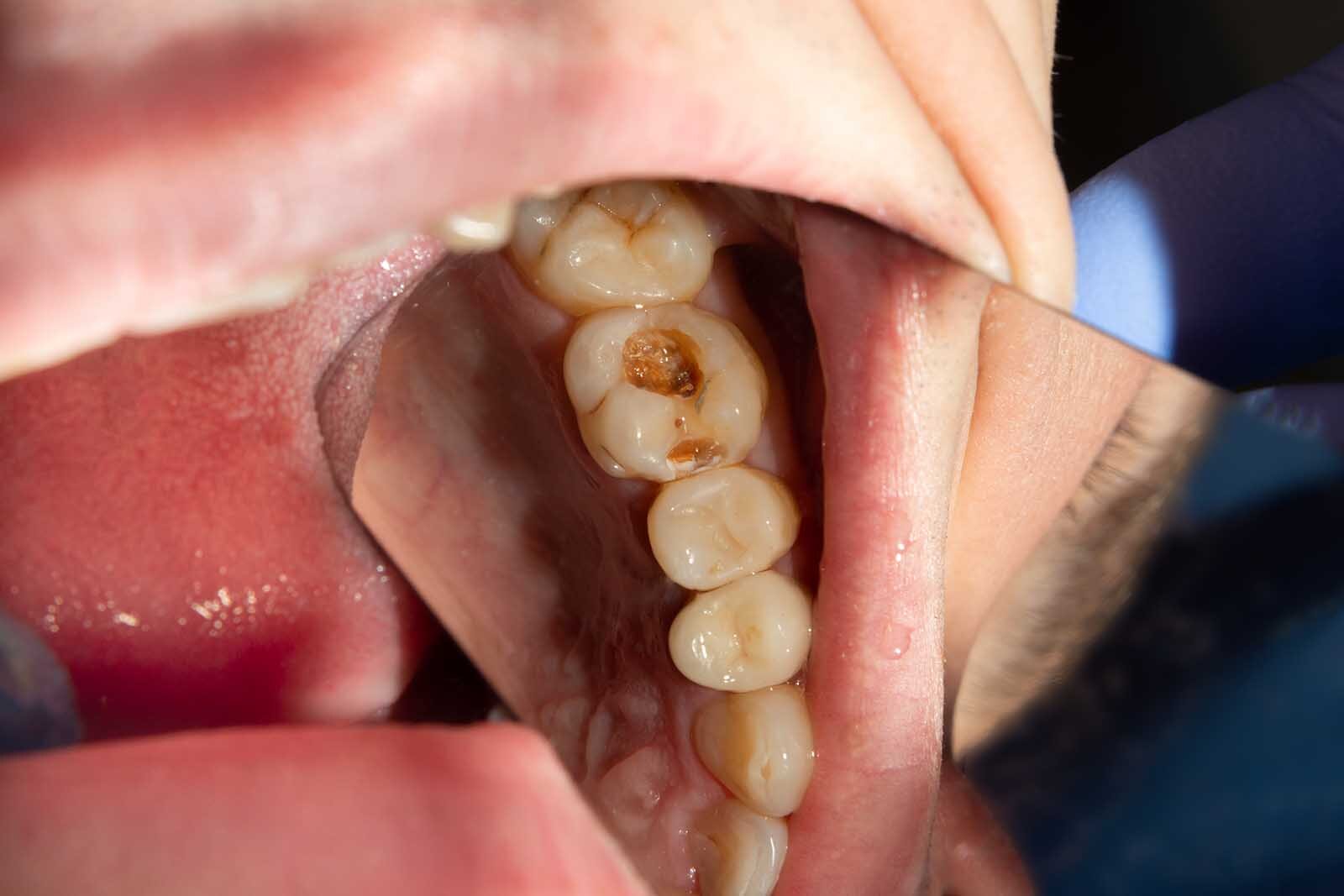 What are the signs of Dental Decay?