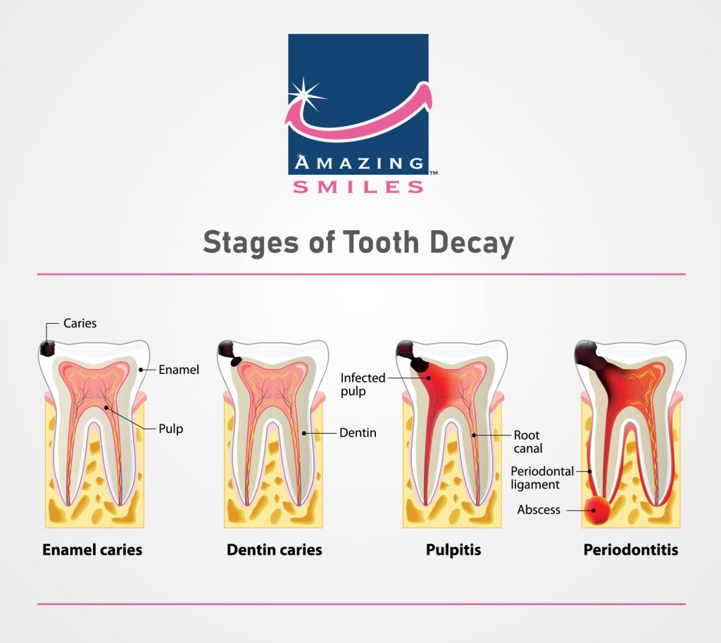 Stages Of Tooth Decay - Tooth Caries - Amazing Smiles