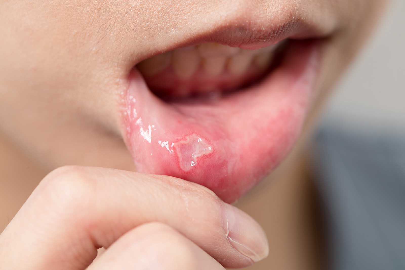 Canker Sores - How Stress Impacts Oral Health And Hygiene