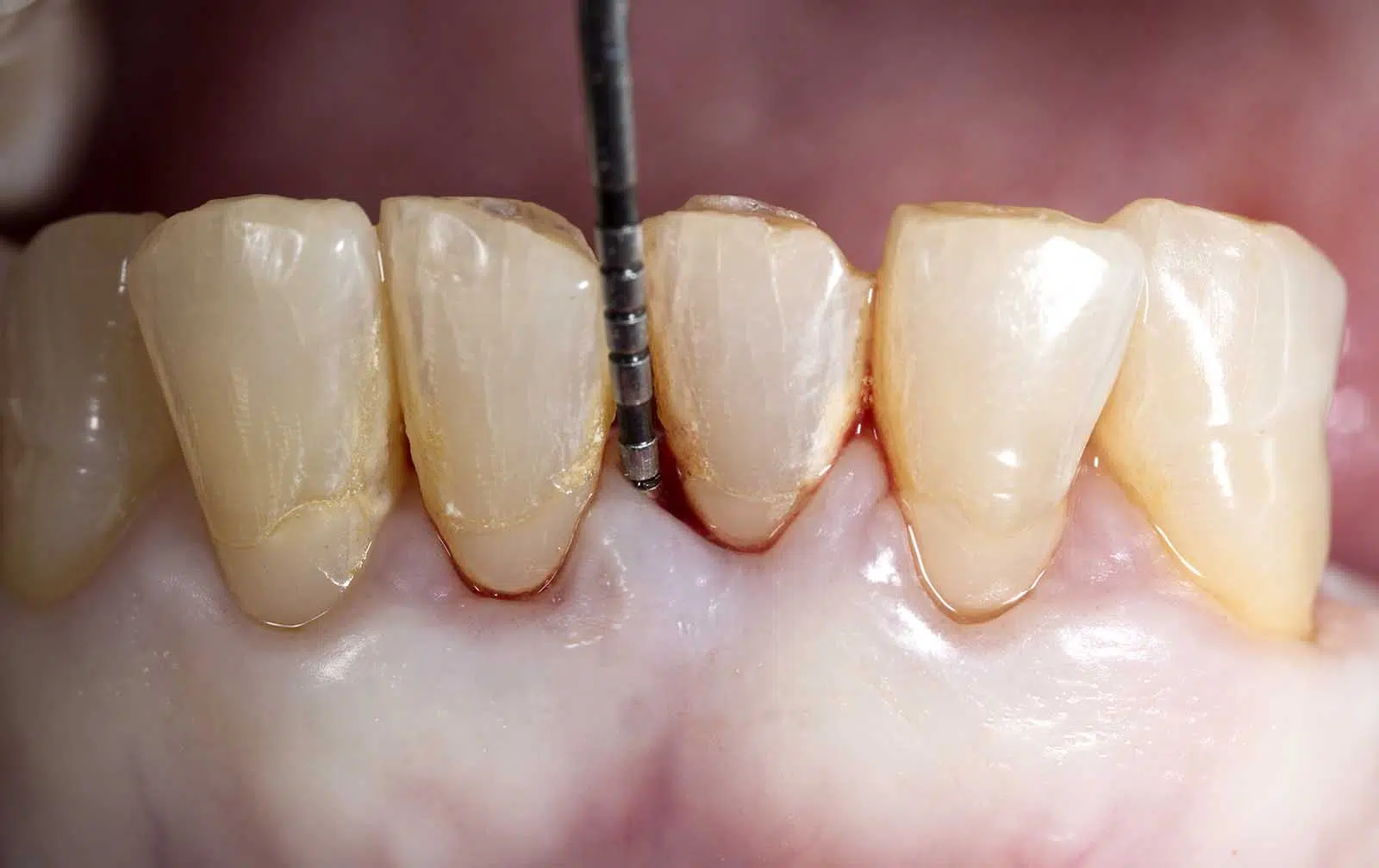 Periodontist Vs Endodontist