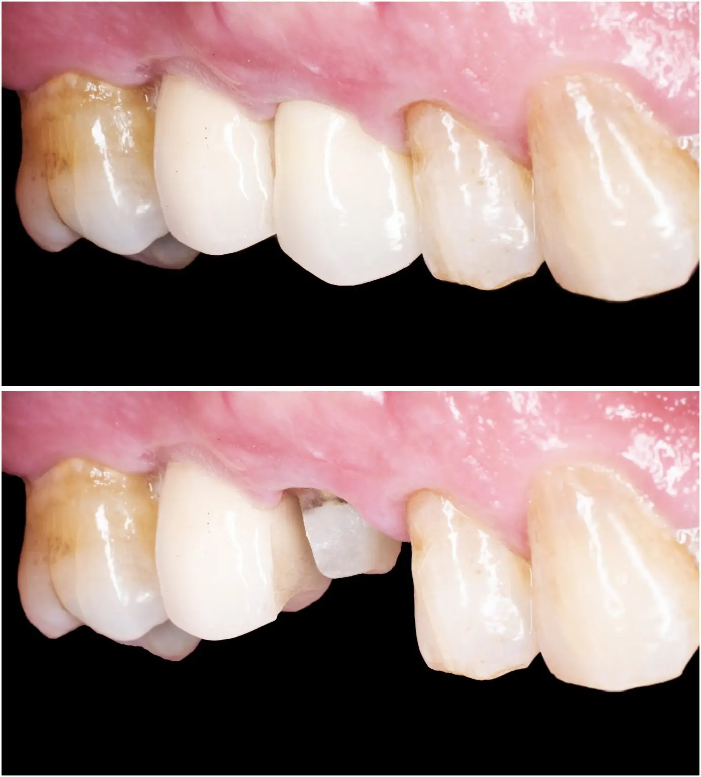 What Is The Difference Between Dental Crowns Vs Porcelain Veneers