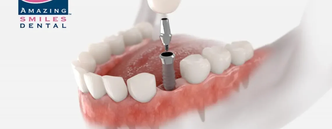 Pros And Cons Of Dental Implants