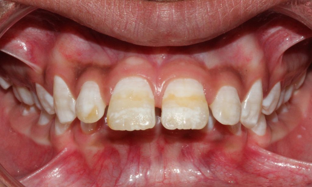 What Is Fluorosis And How To Treat It? - Amazing Smiles