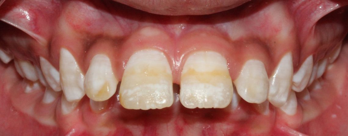 What are the symptoms of fluorosis