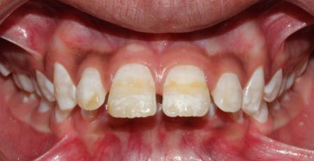 What are the symptoms of Fluorosis