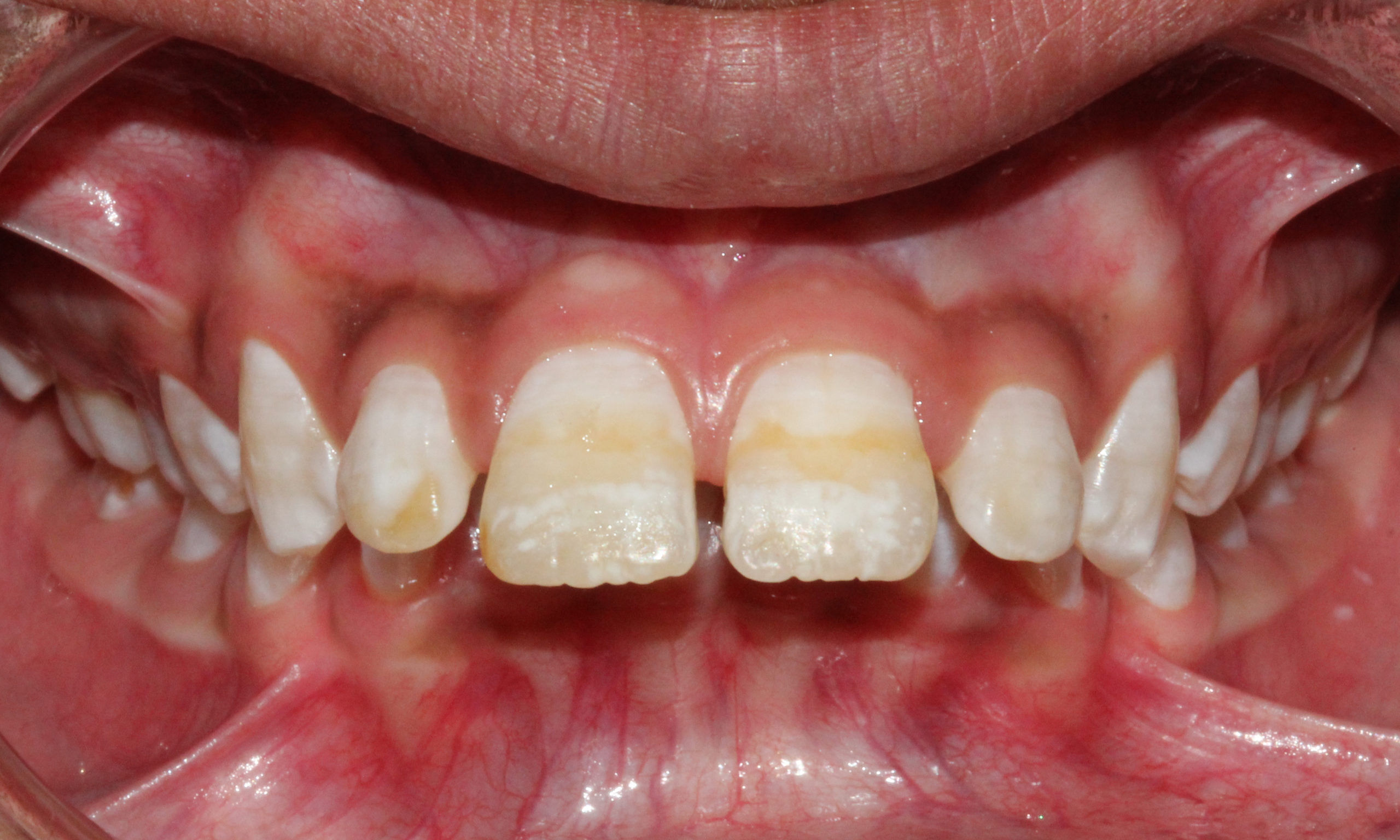 What are the symptoms of Fluorosis