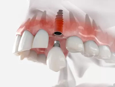 What do I do if my dental implant has broken