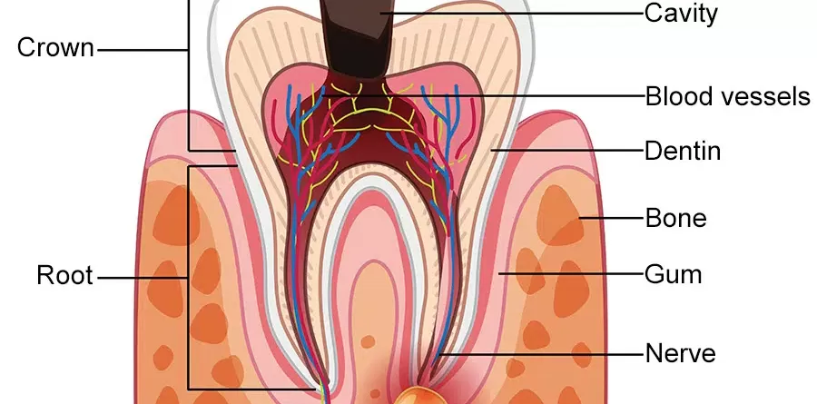 What Is A Gum Abscess