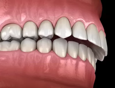 What is an Overbite