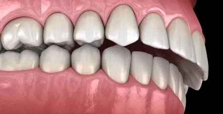 What is an Overbite