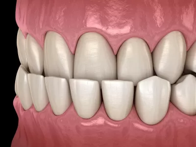 What is an Underbite? - Amazing Smiles Dental Braces