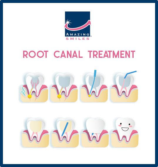 root canal treatment - Amazing Smiles