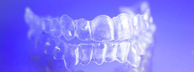 Clear Aligners