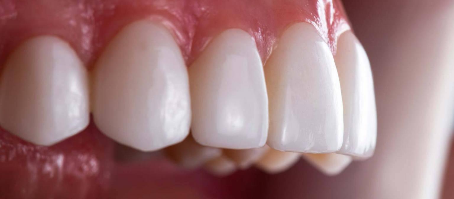 Composite Bonding Amazing Smiles Cosmetic Dentist Near Me