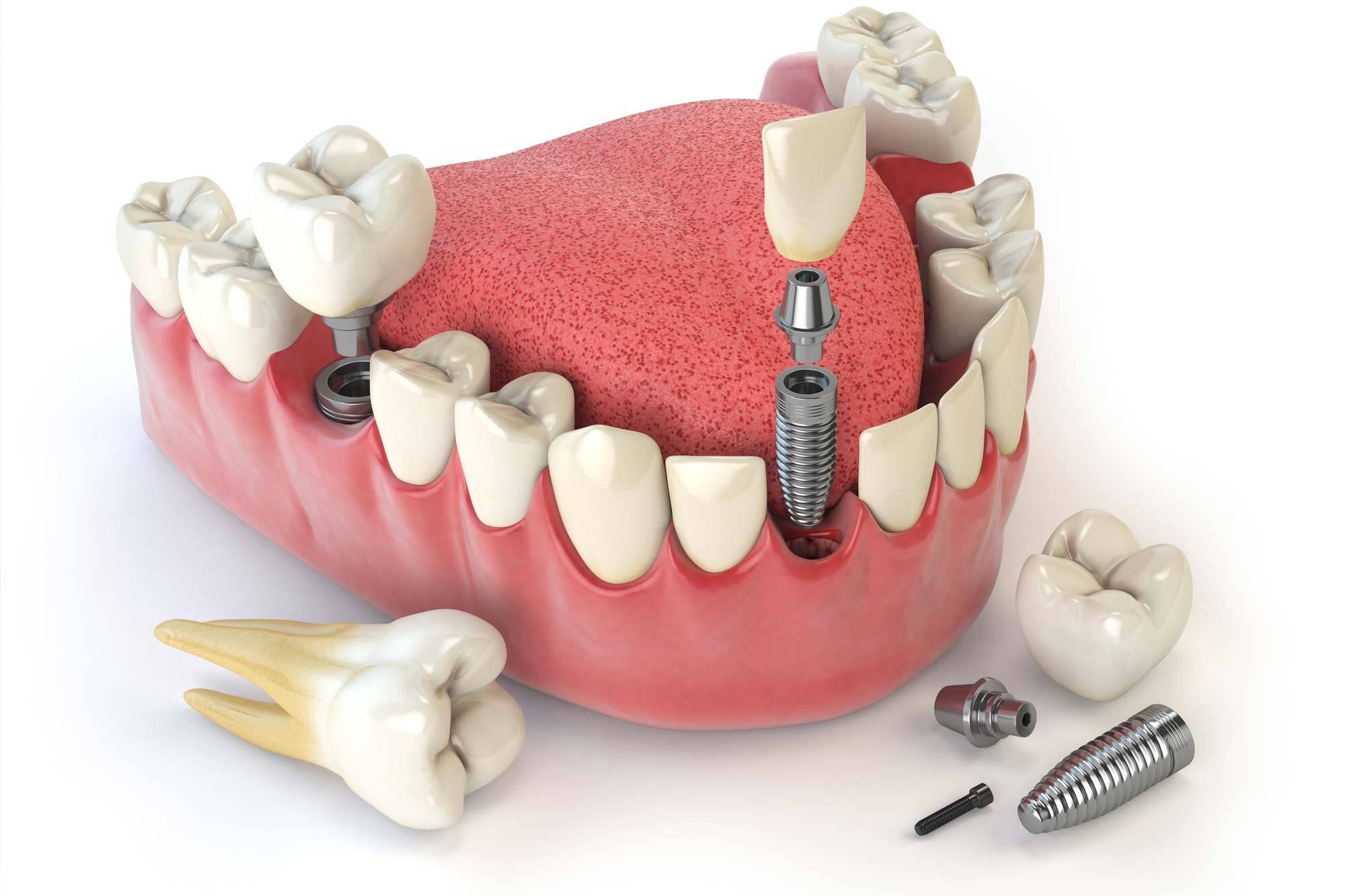 Implant Dentist