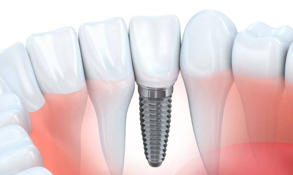 Single Tooth Implant